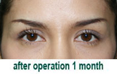 plastic-surgery-blepharoplasty